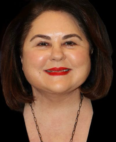 Neck Lift Before & After Gallery - Patient 248936 - Image 2