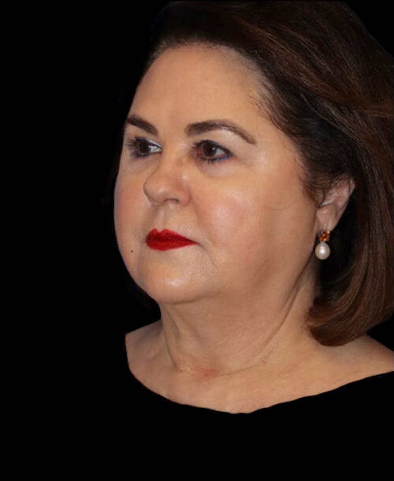 Neck Lift Before & After Gallery - Patient 248936 - Image 3