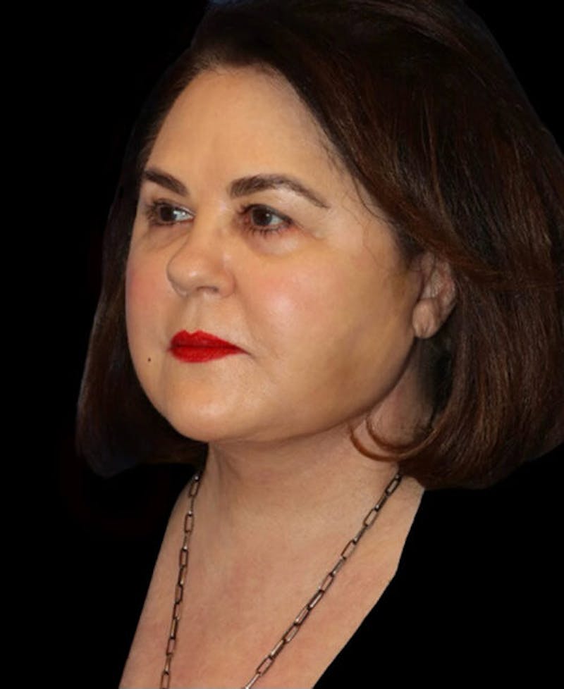 Neck Lift Before & After Gallery - Patient 248936 - Image 4