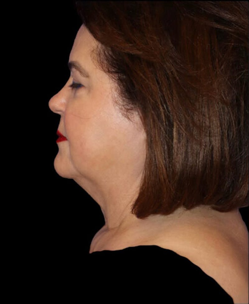Neck Lift Before & After Gallery - Patient 248936 - Image 5