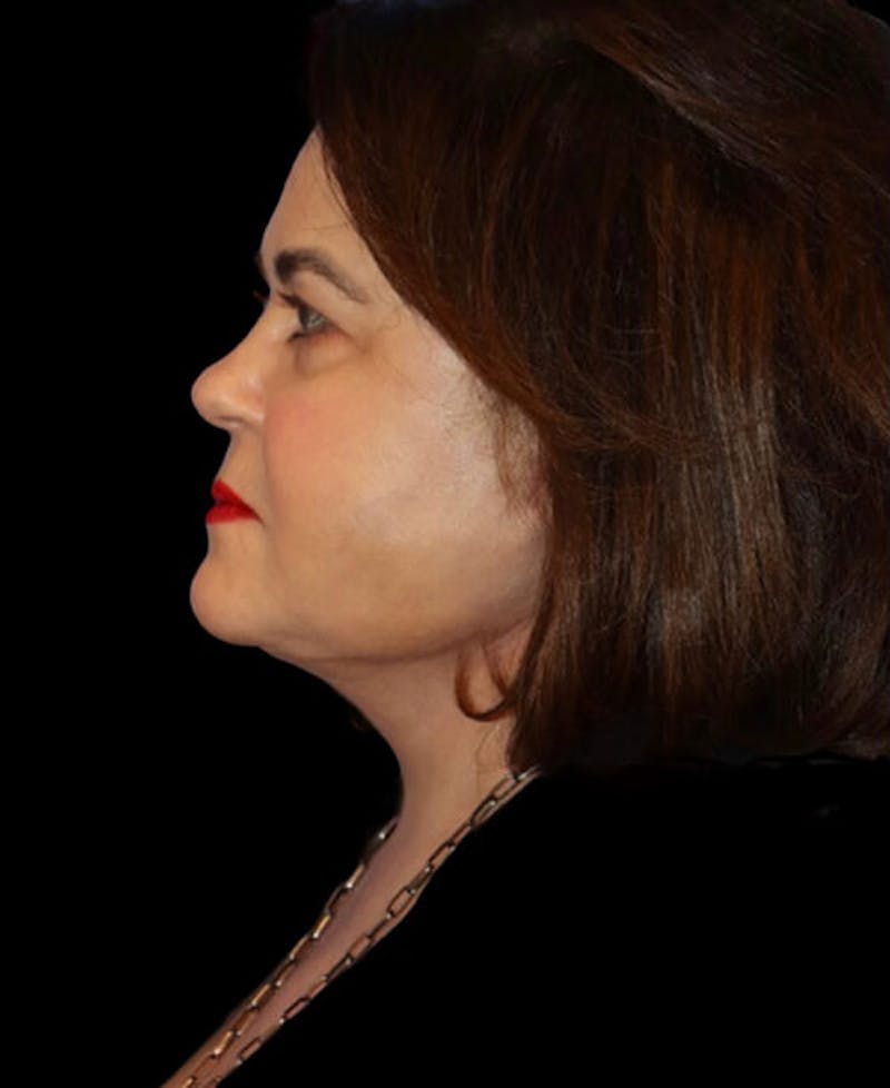 Neck Lift Before & After Gallery - Patient 248936 - Image 6