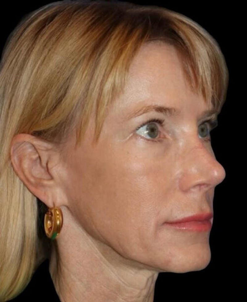 Neck Lift Before & After Gallery - Patient 140179 - Image 3