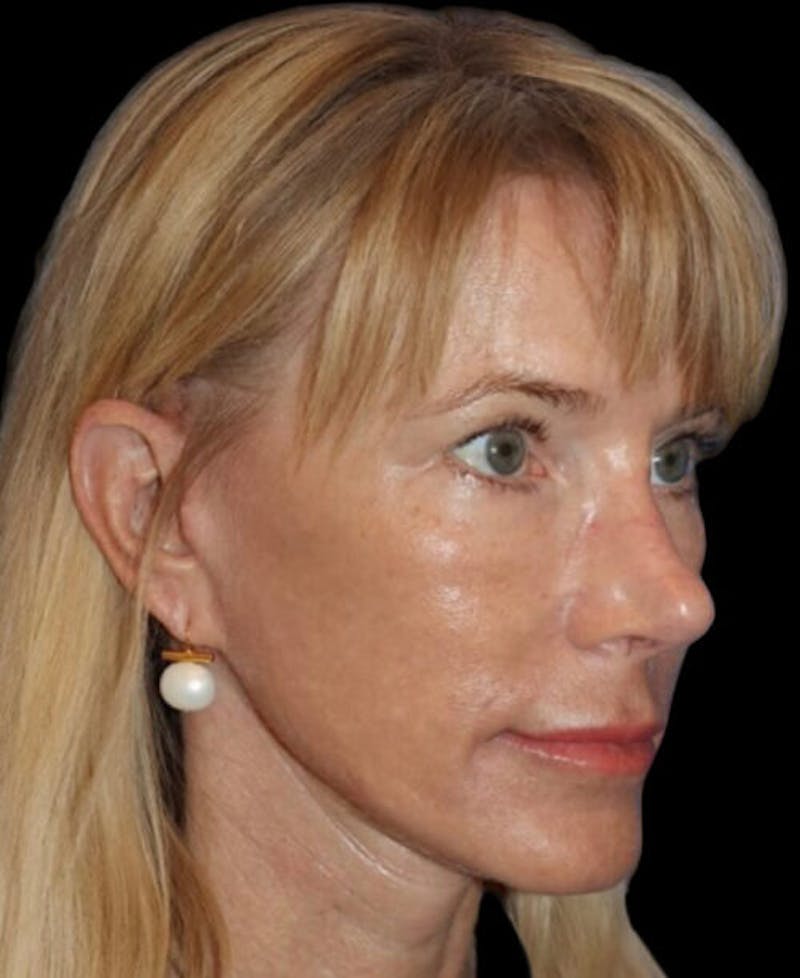 Neck Lift Before & After Gallery - Patient 140179 - Image 4