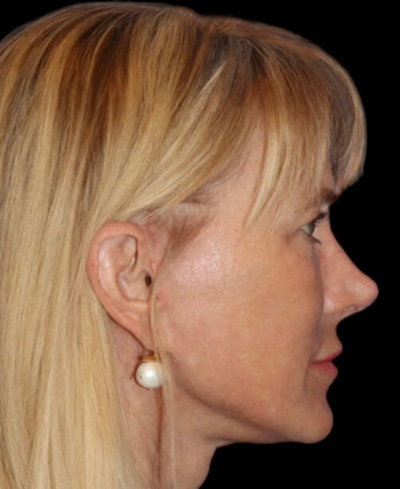 Neck Lift Before & After Gallery - Patient 140179 - Image 6