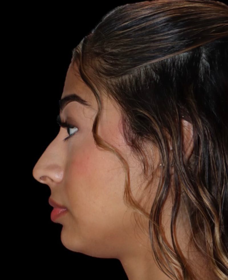 Rhinoplasty Before & After Gallery - Patient 625349 - Image 1
