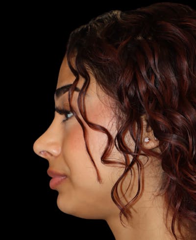 Rhinoplasty Before & After Gallery - Patient 625349 - Image 2