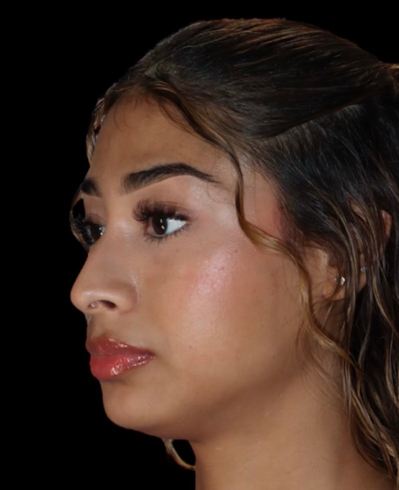 Rhinoplasty Before & After Gallery - Patient 625349 - Image 3
