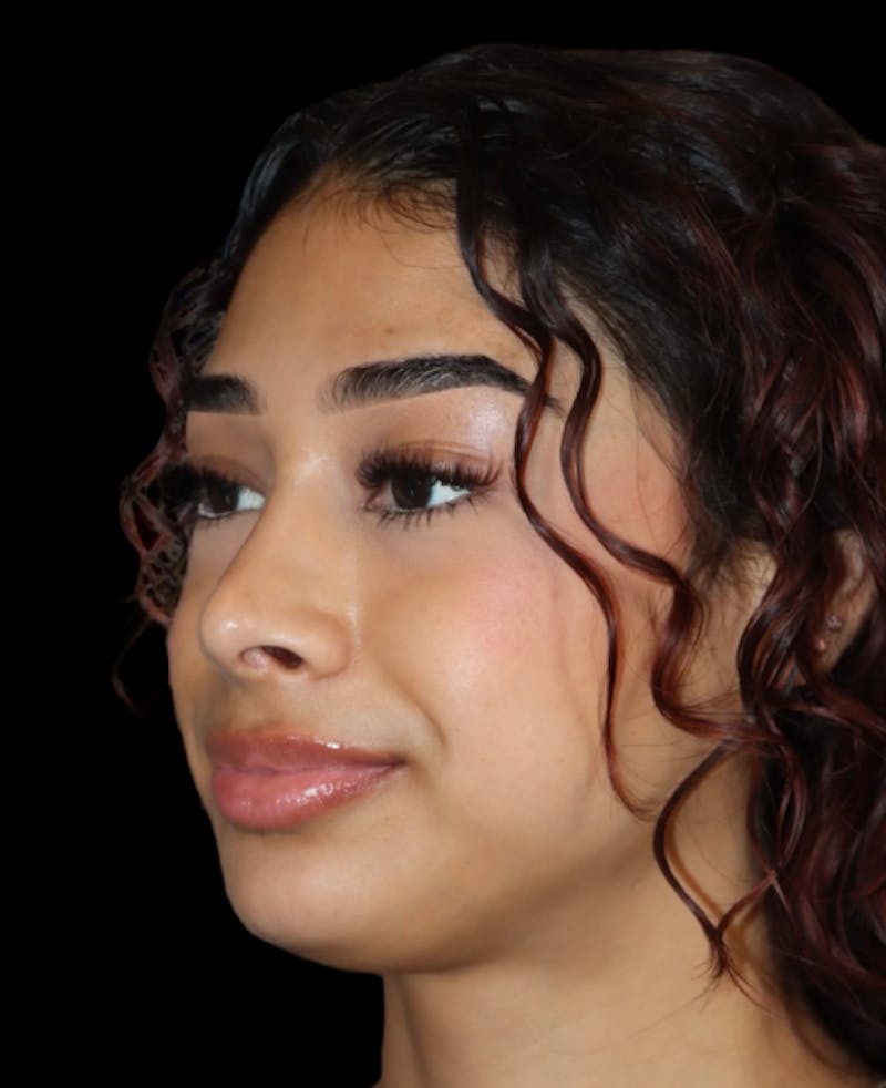 Rhinoplasty Before & After Gallery - Patient 625349 - Image 4