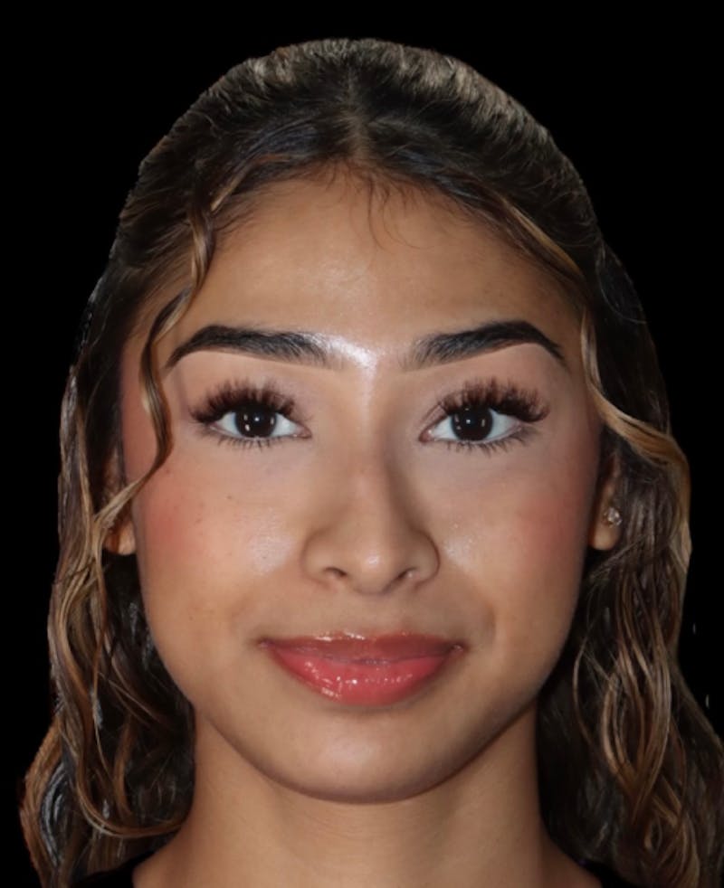 Rhinoplasty Before & After Gallery - Patient 625349 - Image 5