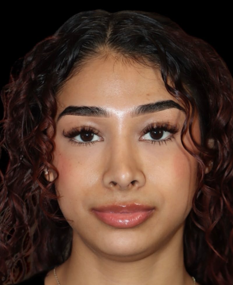 Rhinoplasty Before & After Gallery - Patient 625349 - Image 6