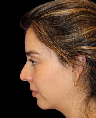 Rhinoplasty Before & After Gallery - Patient 183957 - Image 1