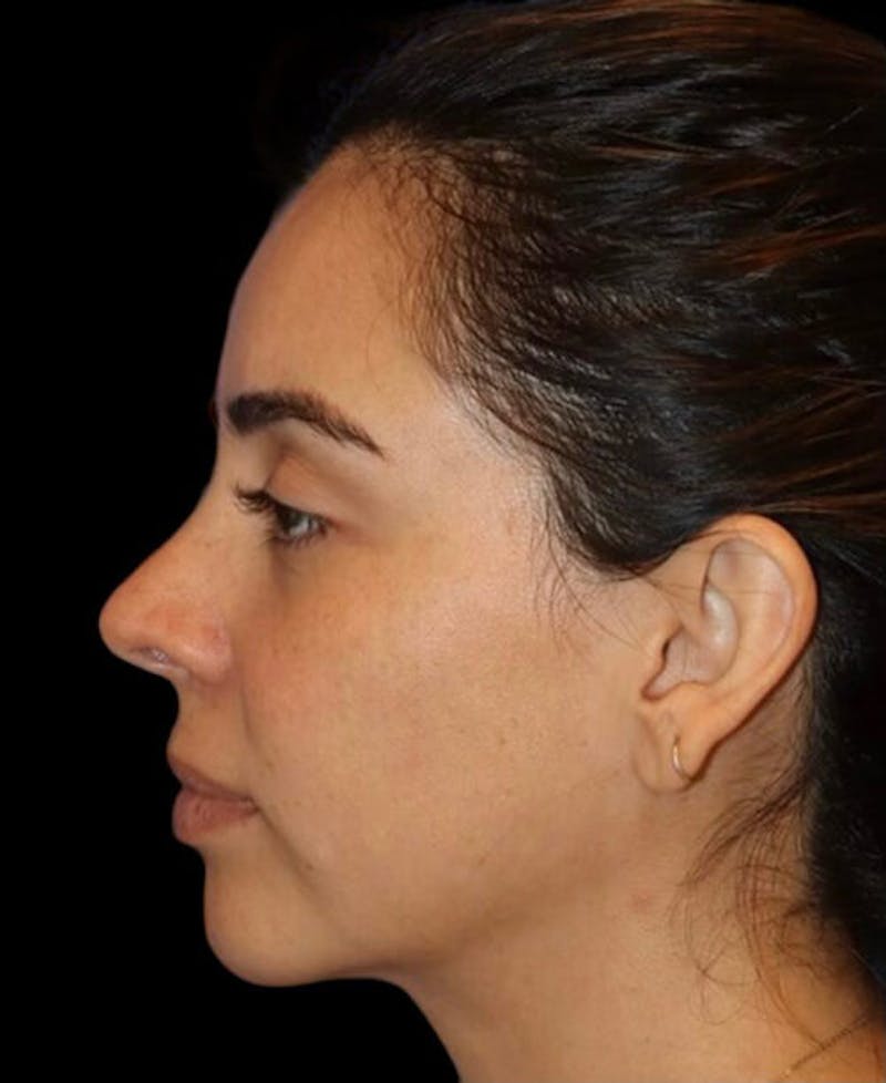 Rhinoplasty Before & After Gallery - Patient 183957 - Image 2