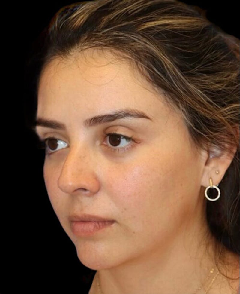 Rhinoplasty Before & After Gallery - Patient 183957 - Image 3