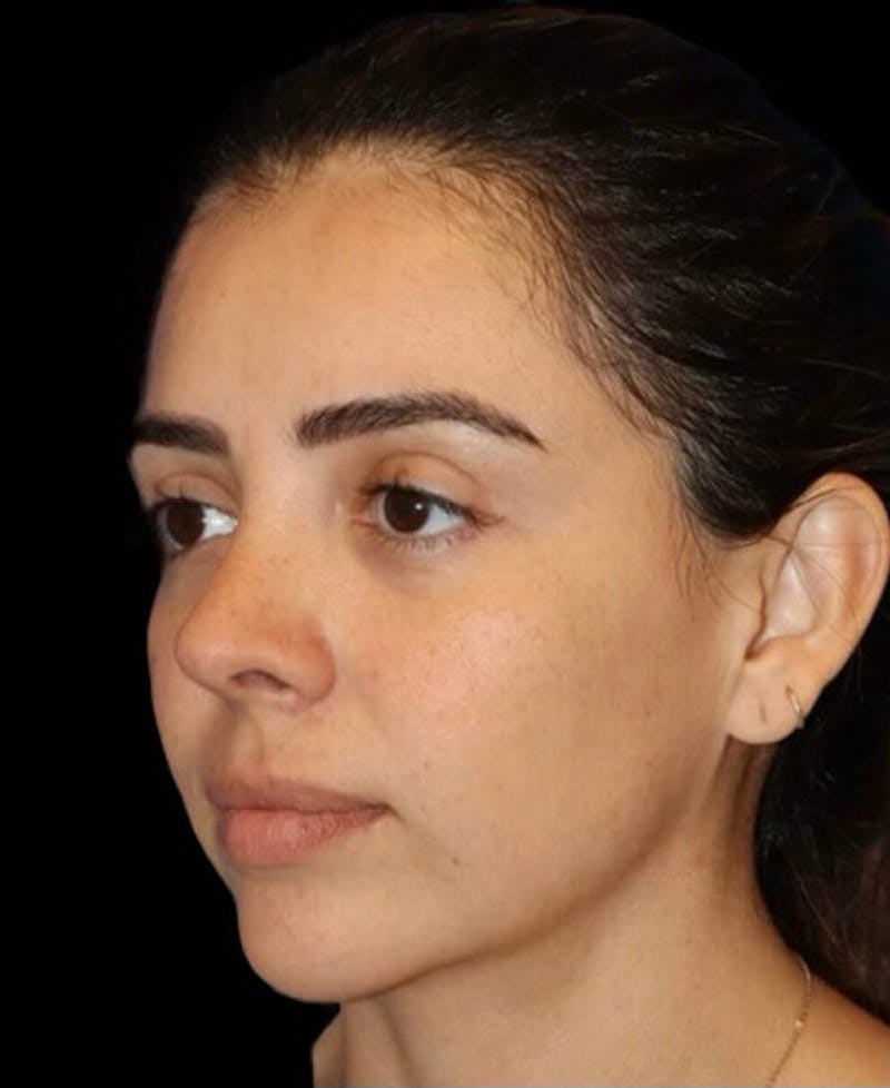 Rhinoplasty Before & After Gallery - Patient 183957 - Image 4