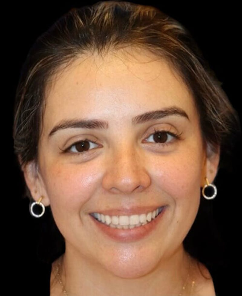 Rhinoplasty Before & After Gallery - Patient 183957 - Image 5