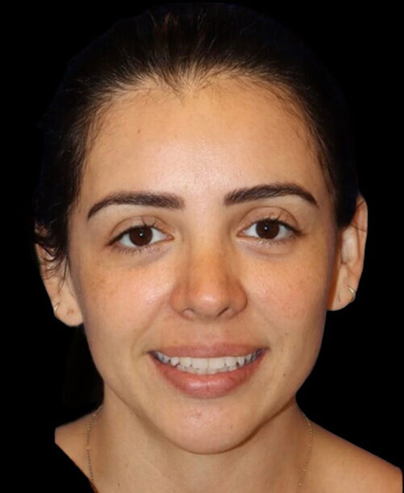 Rhinoplasty Before & After Gallery - Patient 183957 - Image 6