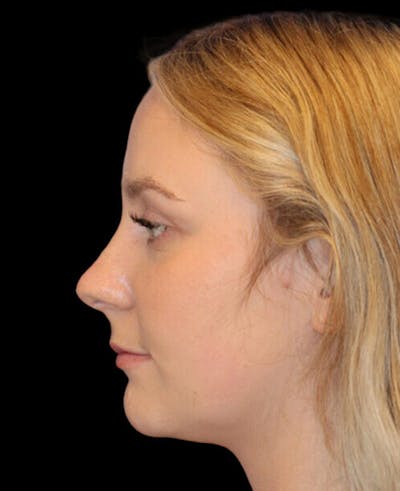 Rhinoplasty Before & After Gallery - Patient 401815 - Image 1