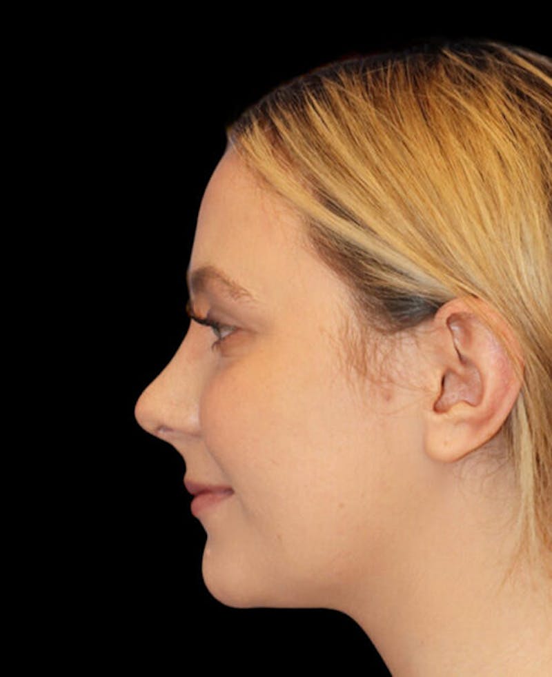 Rhinoplasty Before & After Gallery - Patient 401815 - Image 2