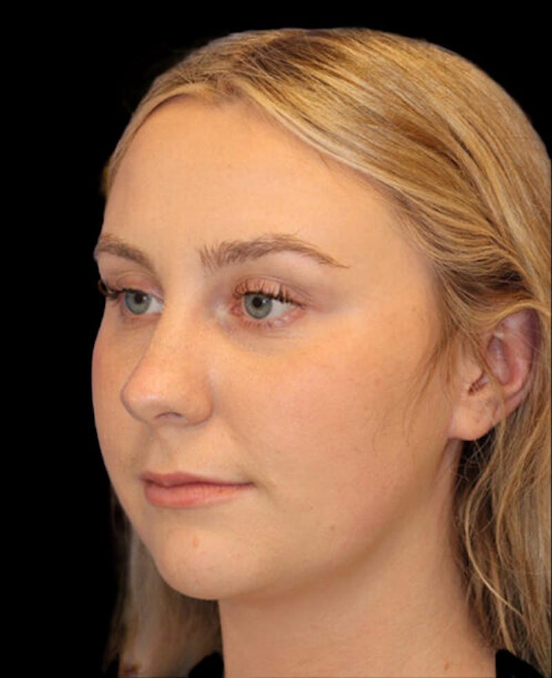 Rhinoplasty Before & After Gallery - Patient 401815 - Image 3