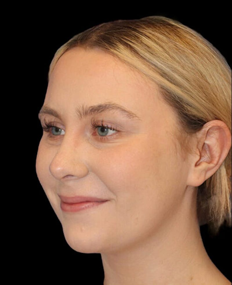 Rhinoplasty Before & After Gallery - Patient 401815 - Image 4