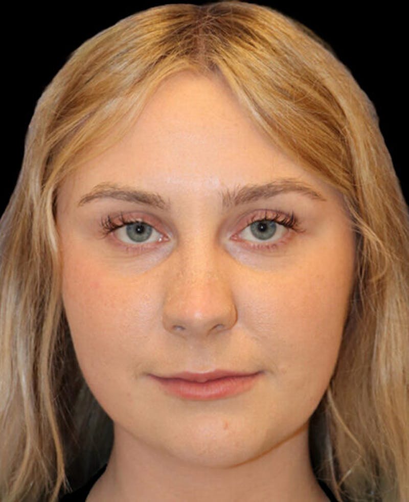 Rhinoplasty Before & After Gallery - Patient 401815 - Image 5