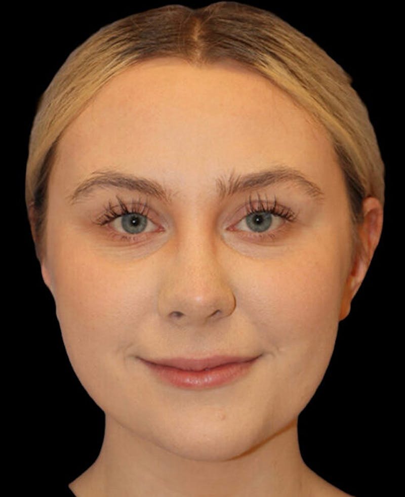 Rhinoplasty Before & After Gallery - Patient 401815 - Image 6
