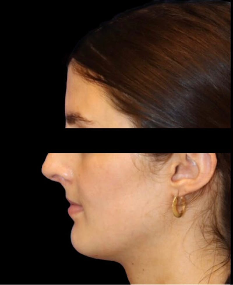 Rhinoplasty Before & After Gallery - Patient 322386 - Image 1