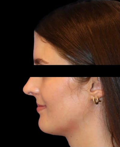 Rhinoplasty Before & After Gallery - Patient 322386 - Image 2