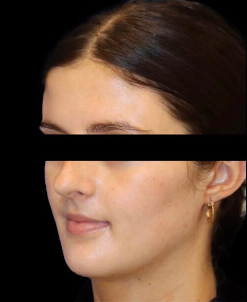 Rhinoplasty Before & After Gallery - Patient 322386 - Image 3