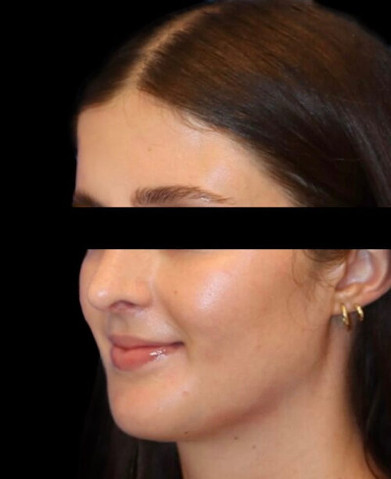 Rhinoplasty Before & After Gallery - Patient 322386 - Image 4