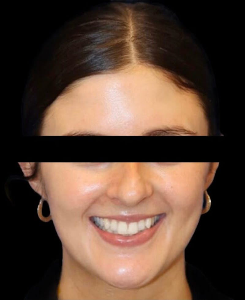 Rhinoplasty Before & After Gallery - Patient 322386 - Image 5