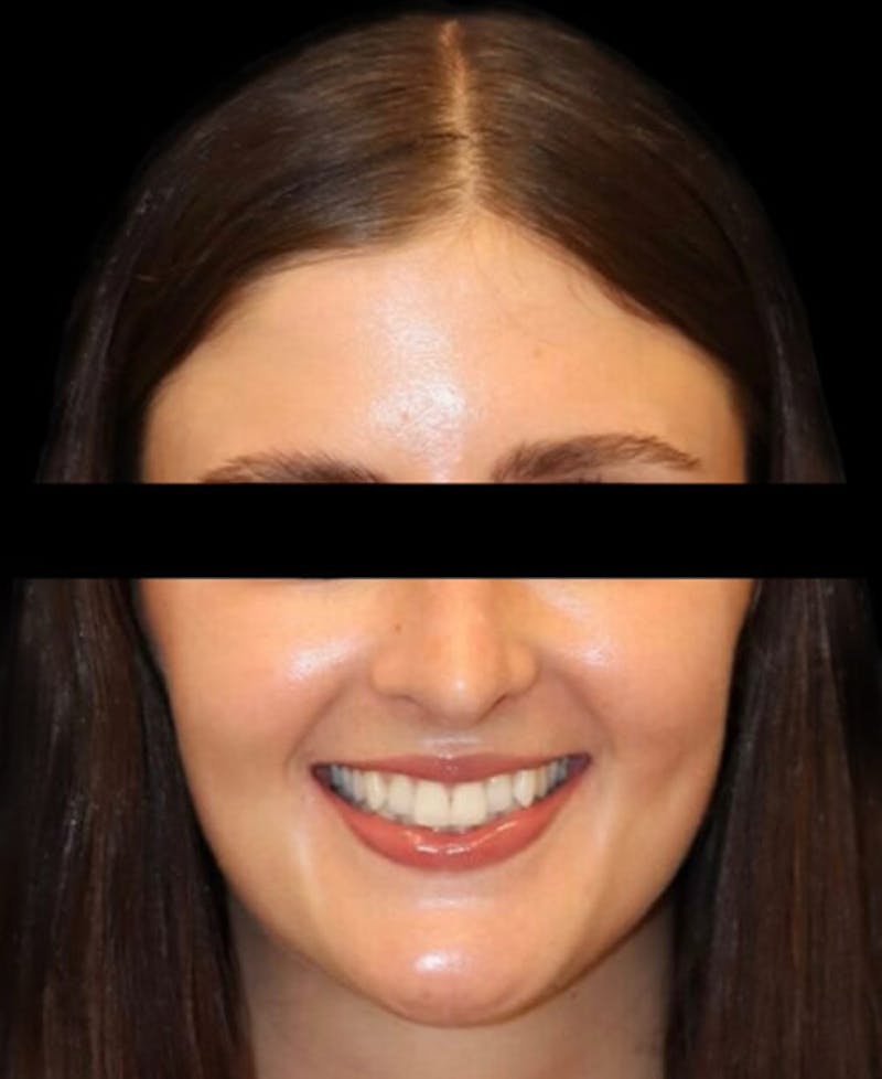 Rhinoplasty Before & After Gallery - Patient 322386 - Image 6