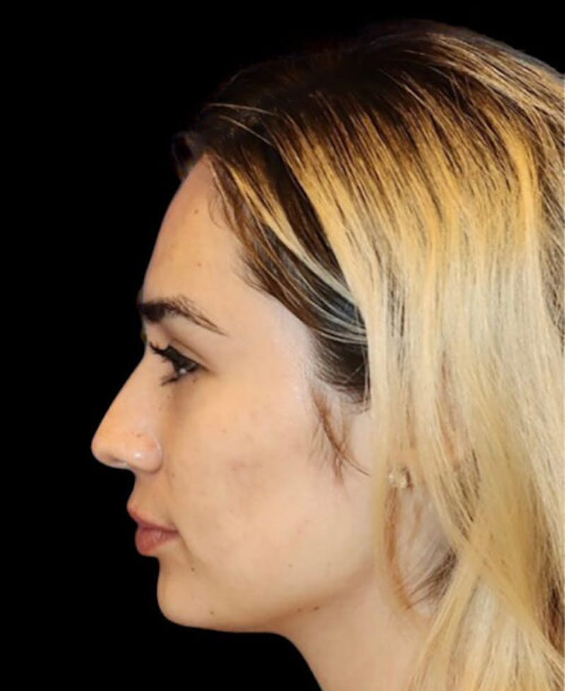 Rhinoplasty Before & After Gallery - Patient 429787 - Image 1