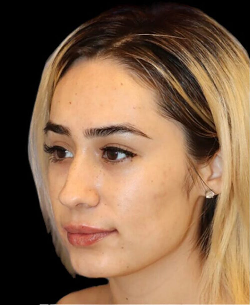 Rhinoplasty Before & After Gallery - Patient 429787 - Image 3