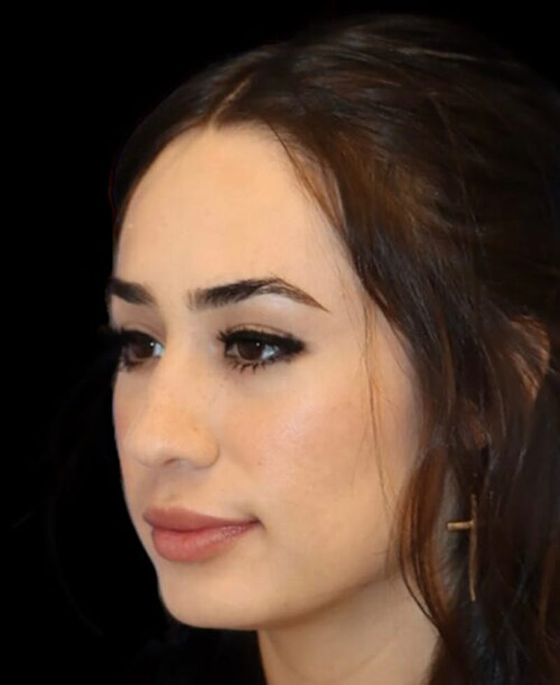 Rhinoplasty Before & After Gallery - Patient 429787 - Image 4