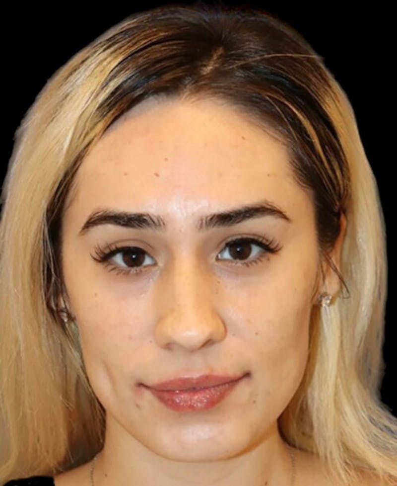 Rhinoplasty Before & After Gallery - Patient 429787 - Image 5