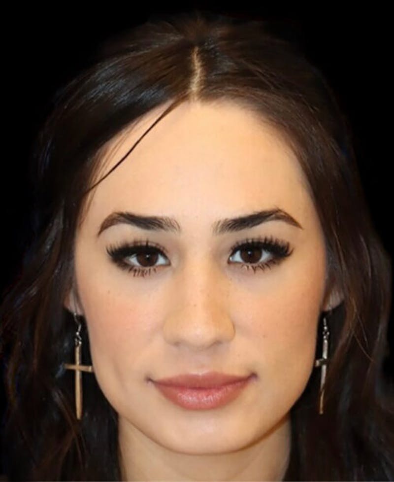 Rhinoplasty Before & After Gallery - Patient 429787 - Image 6