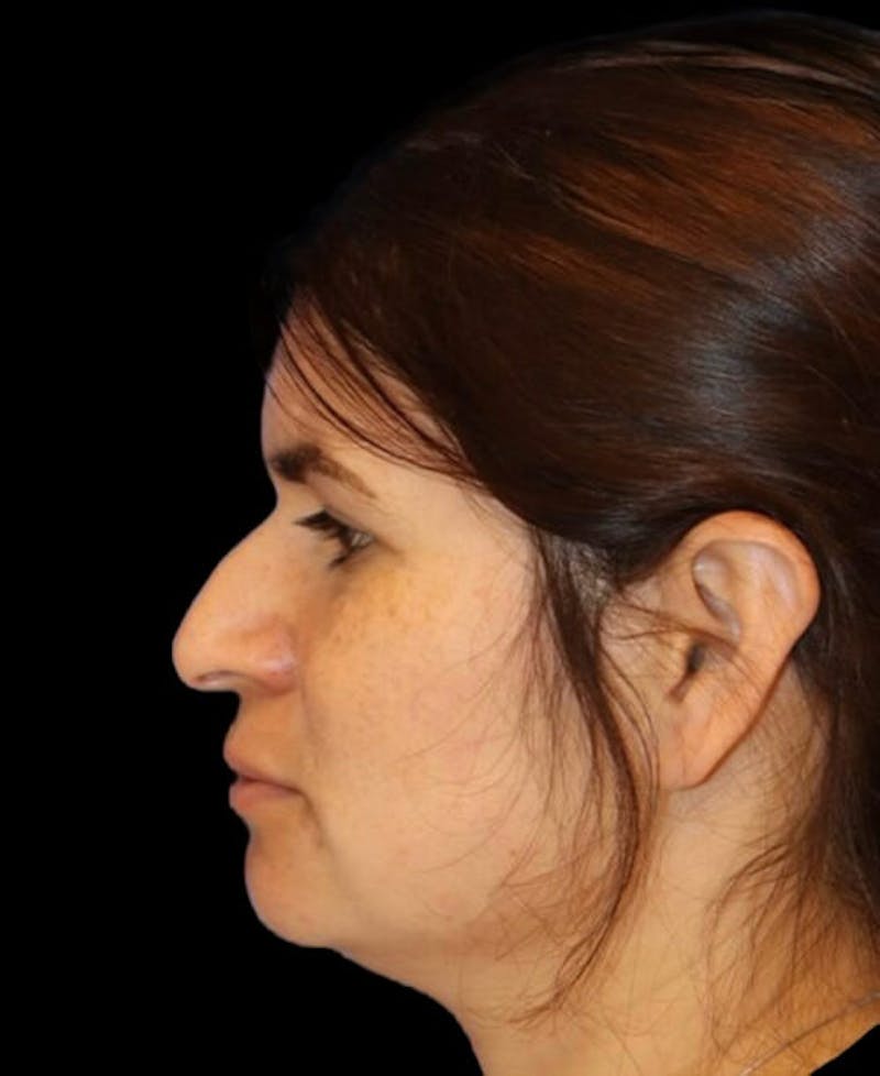 Rhinoplasty Before & After Gallery - Patient 273321 - Image 1