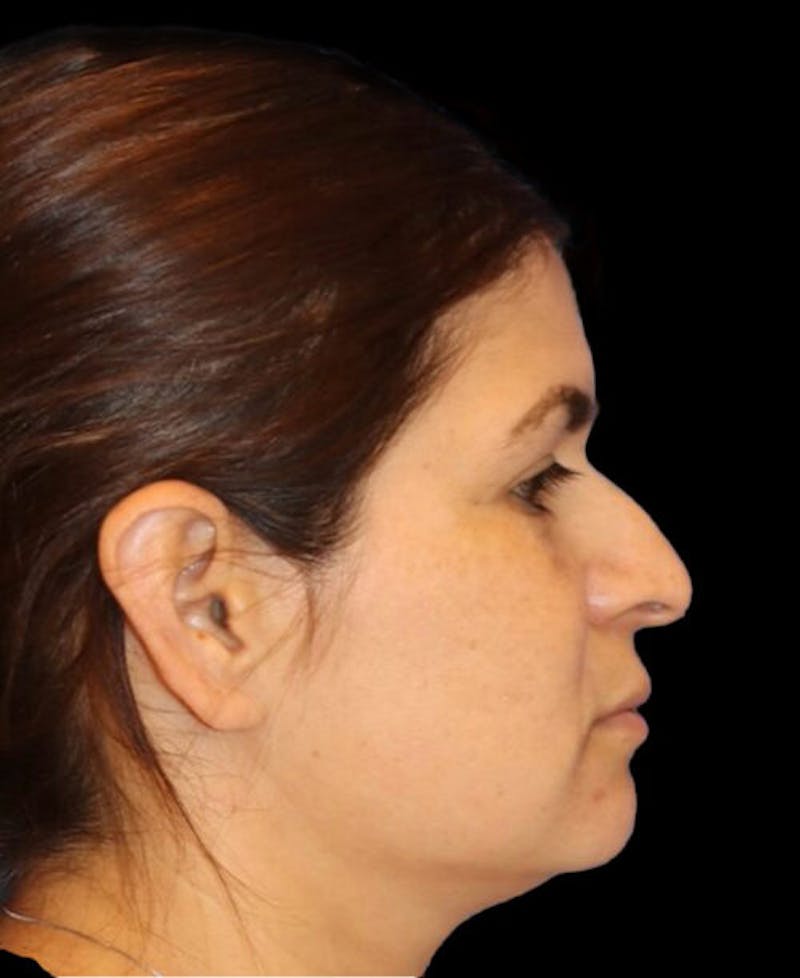 Rhinoplasty Before & After Gallery - Patient 273321 - Image 3