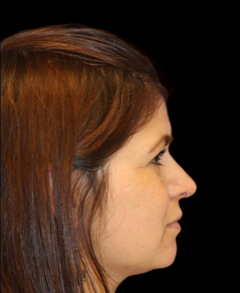 Rhinoplasty Before & After Gallery - Patient 273321 - Image 4