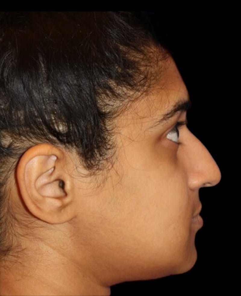 Rhinoplasty Before & After Gallery - Patient 902796 - Image 1