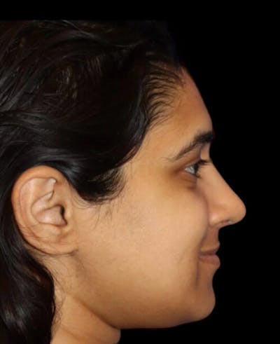 Rhinoplasty Before & After Gallery - Patient 902796 - Image 2
