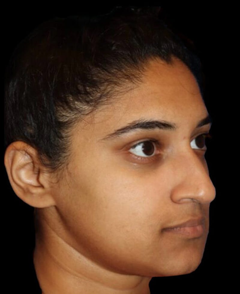 Rhinoplasty Before & After Gallery - Patient 902796 - Image 3