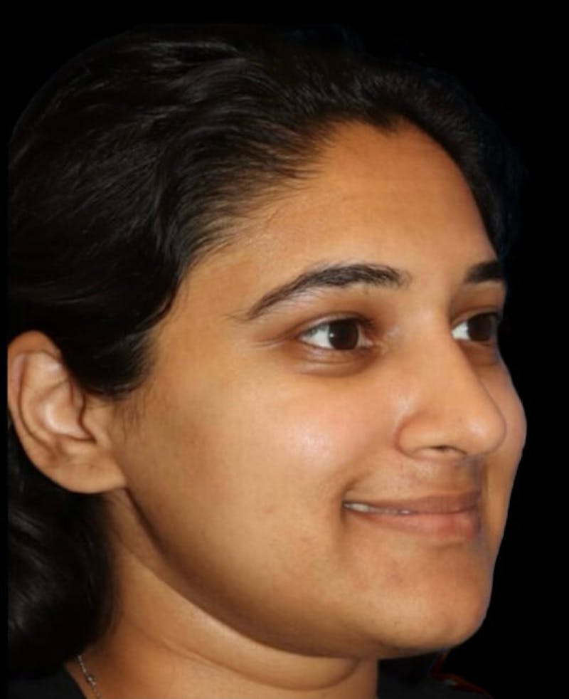 Rhinoplasty Before & After Gallery - Patient 902796 - Image 4