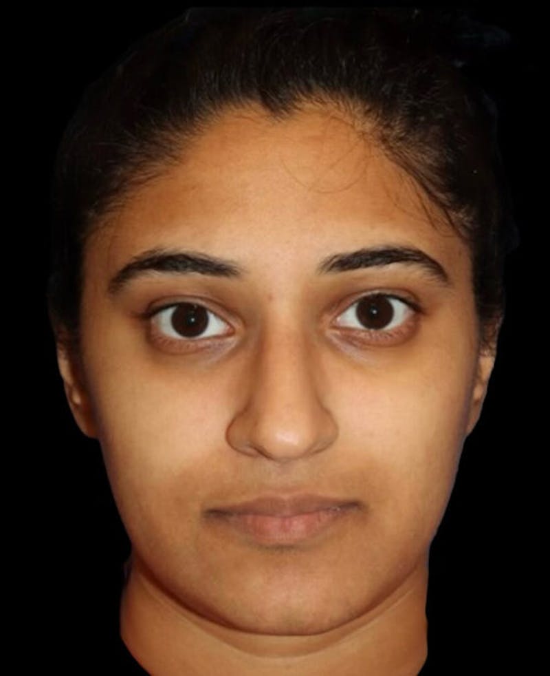 Rhinoplasty Before & After Gallery - Patient 902796 - Image 5