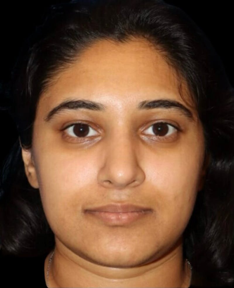 Rhinoplasty Before & After Gallery - Patient 902796 - Image 6