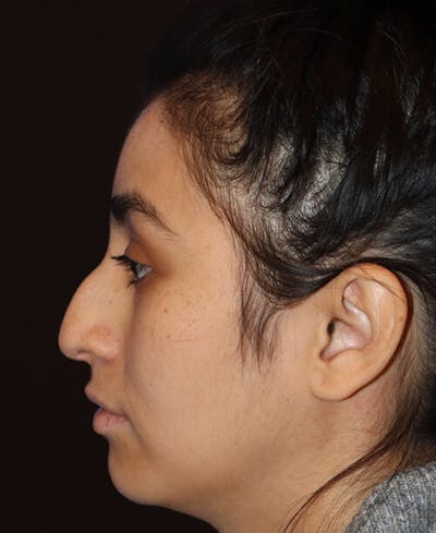 Rhinoplasty Before & After Gallery - Patient 127573 - Image 1