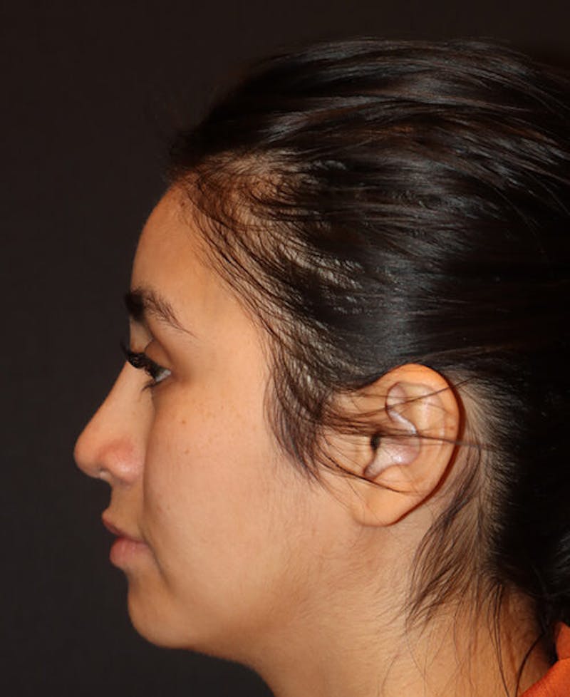 Rhinoplasty Before & After Gallery - Patient 127573 - Image 2