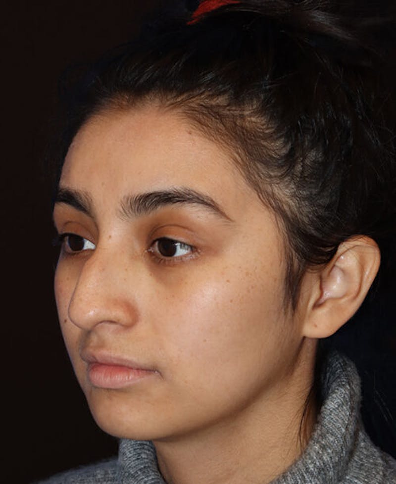 Rhinoplasty Before & After Gallery - Patient 127573 - Image 3