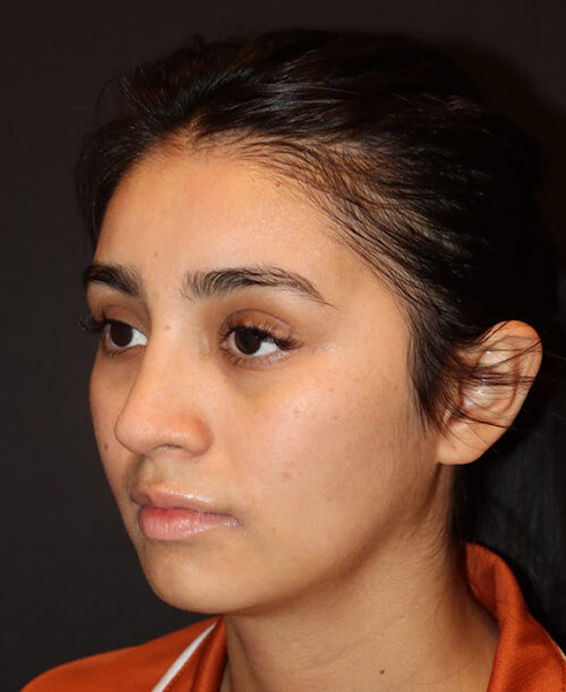 Rhinoplasty Before & After Gallery - Patient 127573 - Image 4